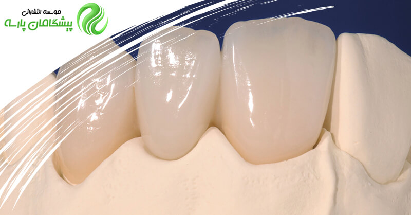 انتخاب بلوک سرامیکی در دندان پزشکی