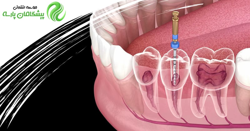 ترمیم و بازسازی دندان‌های روت کانال شده